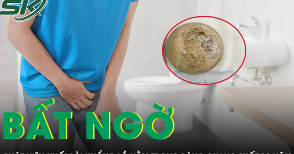 Phát hiện sỏi bàng quang khổng lồ khi bệnh nhân đi khám bệnh khác