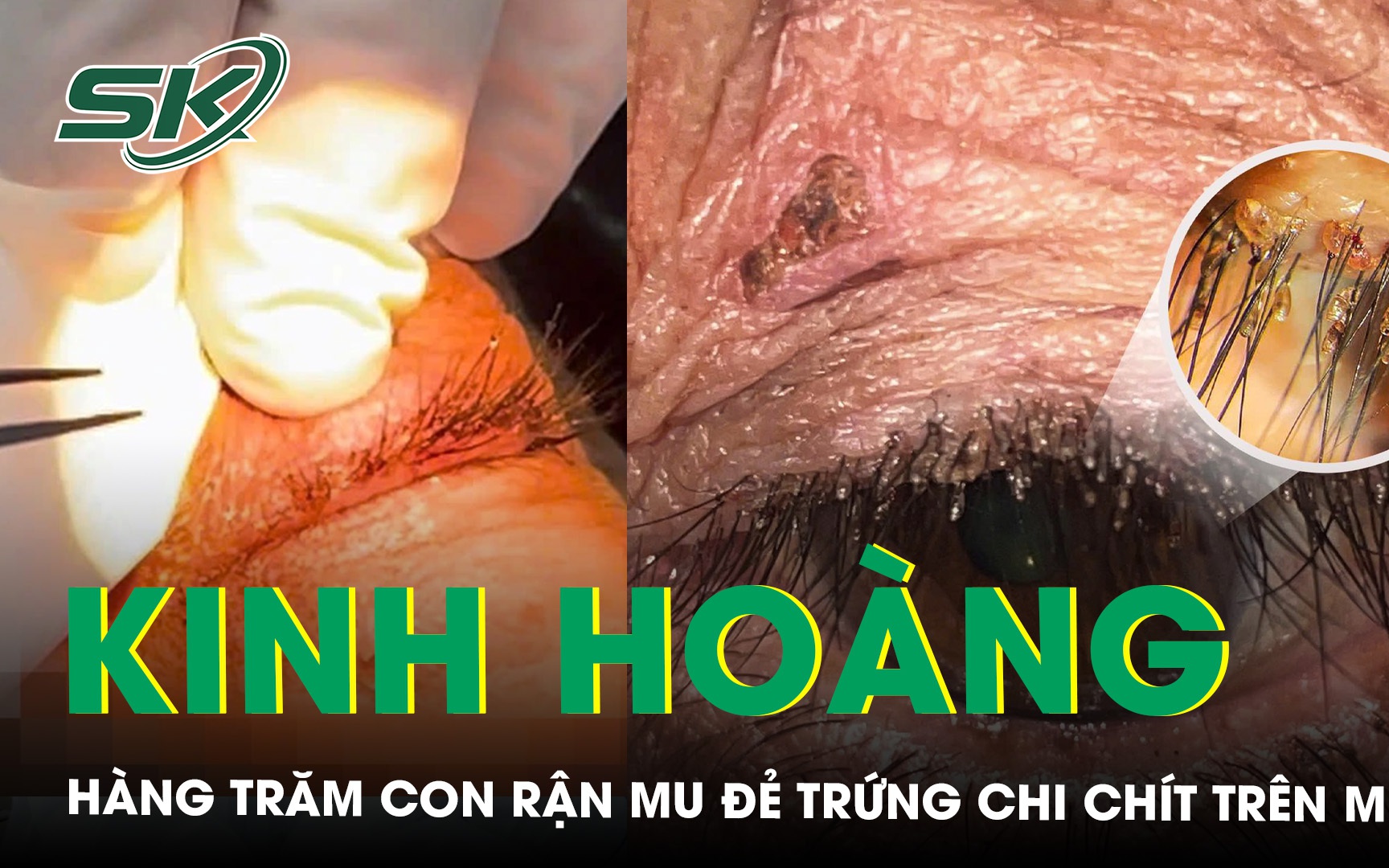 Kinh hoàng hàng trăm con rận mu làm tổ, đẻ trứng chi chít trên mi mắt