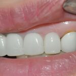 Vì sao bọc răng sứ hay bị viêm nướu?