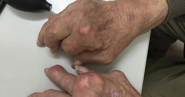 Gout mạn tính gây biến dạng khớp tay, chân xử trí ra sao?