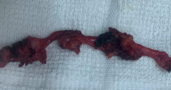 Đau âm ỉ vùng bụng, phát hiện bệnh hiếm nằm sát bàng quang