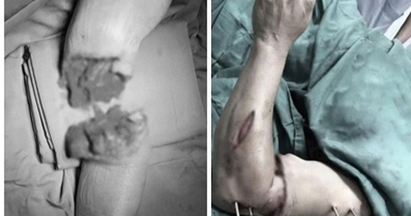 Hồi sinh cánh tay đứt lìa dập nát trong ‘giờ vàng’