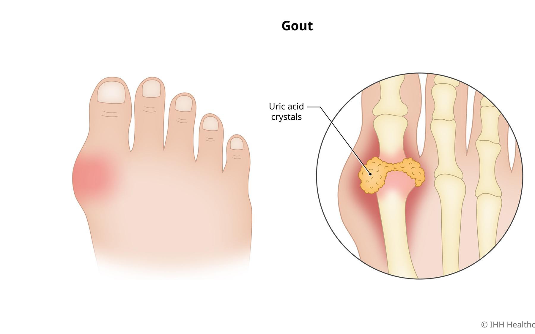 Thiếu vitamin D có thể gây tăng axit uric
