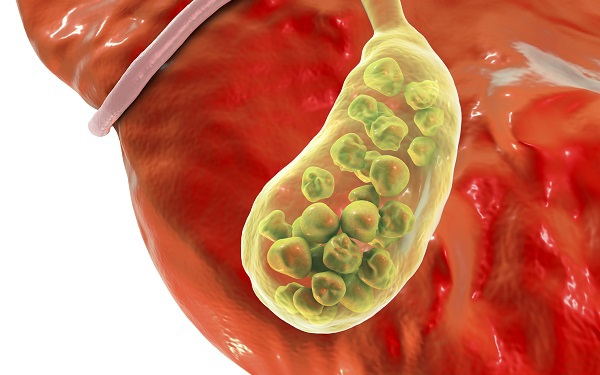 Đau bụng kéo dài cảnh giác với sỏi túi mật