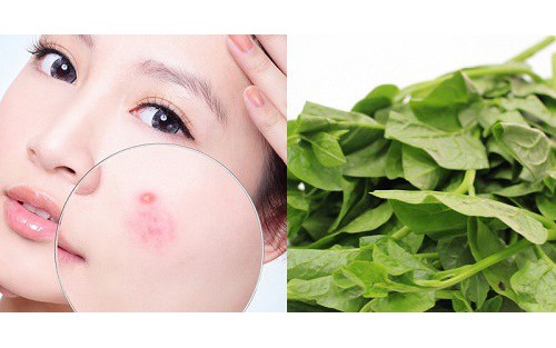 Cách dùng rau mồng tơi chữa lành da mụn trứng cá