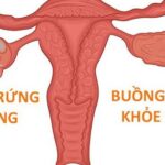 Phụ nữ mắc hội chứng buồng trứng đa nang có mang thai được không?