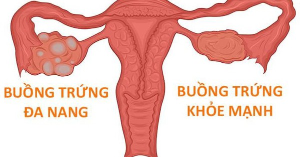 Phụ nữ mắc hội chứng buồng trứng đa nang có mang thai được không?