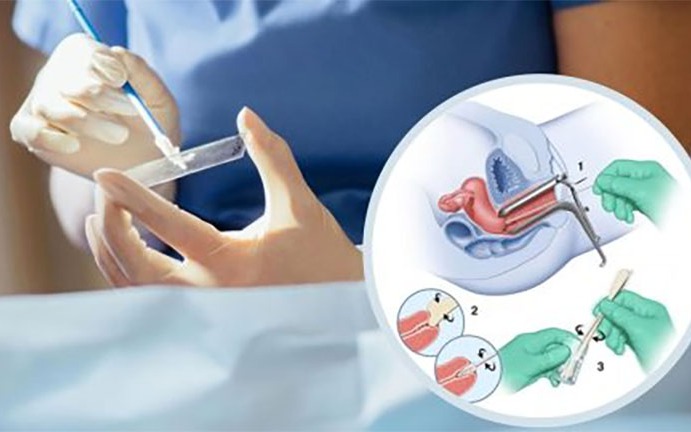 Cách tốt nhất để phát hiện sớm ung thư cổ tử cung