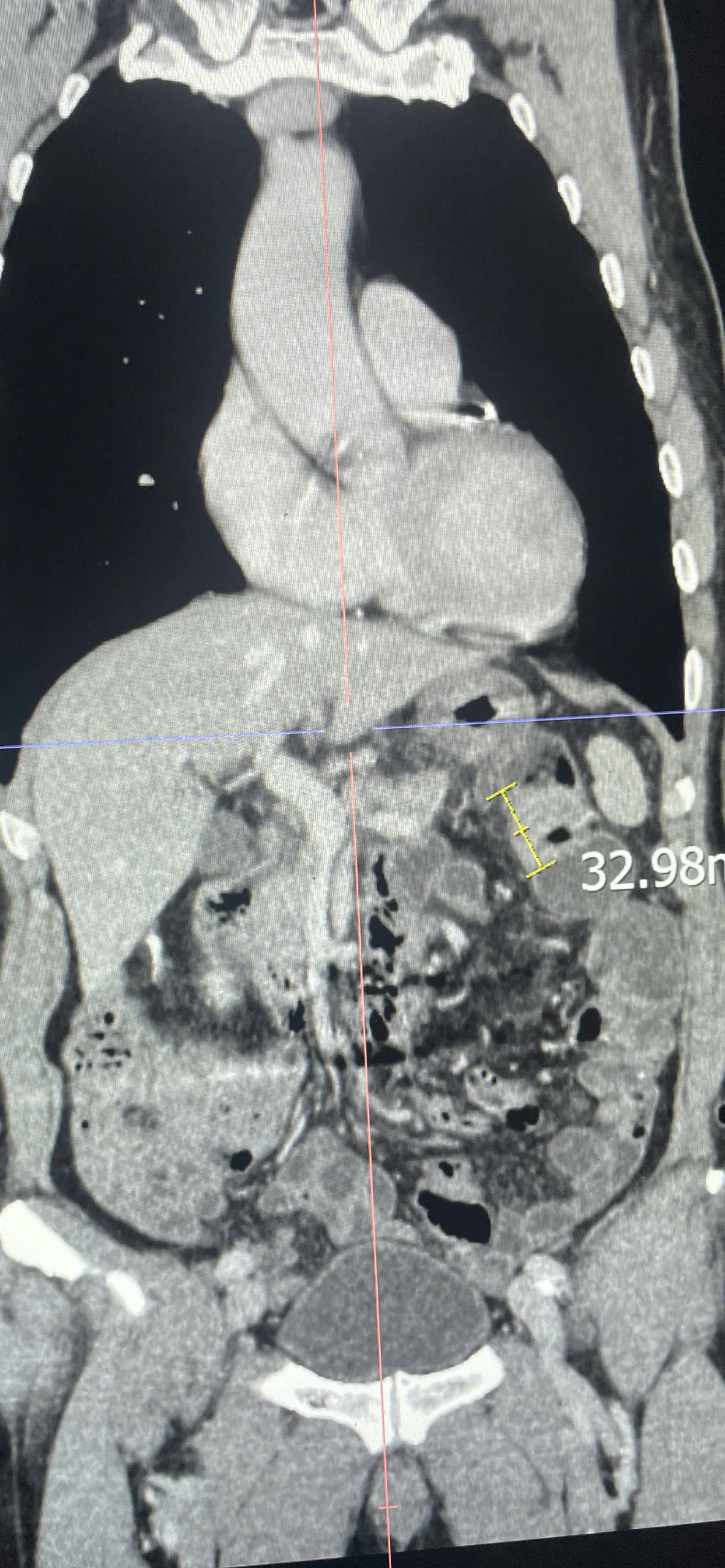 Ung thư có thể tái phát nếu chủ quan sau điều trị- Ảnh 1.