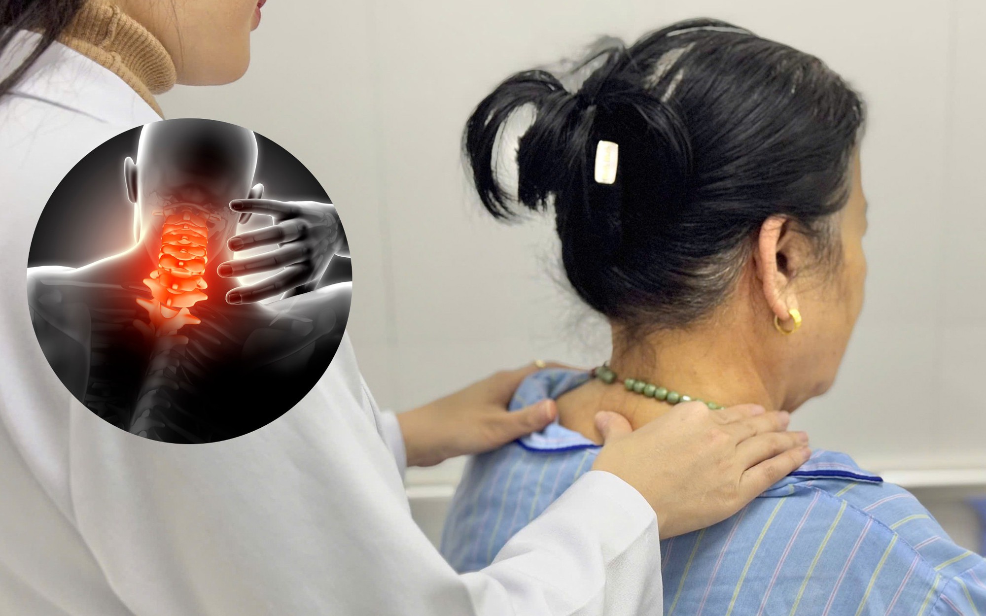 Giảm đau do thoát vị đĩa đệm ở người cao tuổi dùng thuốc như thế nào?- Ảnh 3. Nguy cơ liệt nếu không điều trị thoát vị đĩa đệm