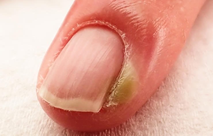 Chín mé ngón tay xử trí ra sao?- Ảnh 2. Chín mé ngón tay xử trí ra sao?- Ảnh 2.