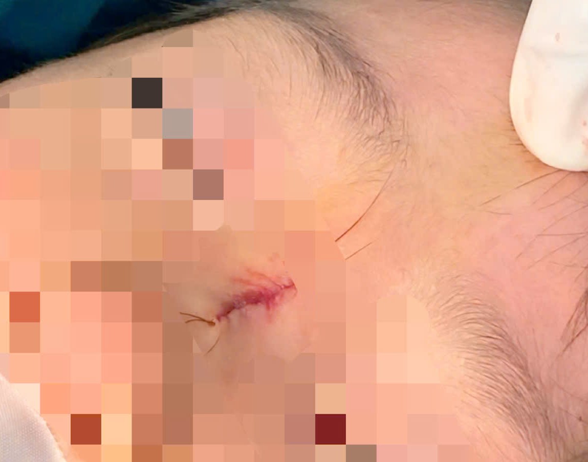 Sưng sống mũi kéo dài ở trẻ, bác sĩ cảnh báo dị tật hiếm gặp- Ảnh 1. Sưng sống mũi kéo dài ở trẻ, bác sĩ cảnh báo dị tật hiếm gặp- Ảnh 1.