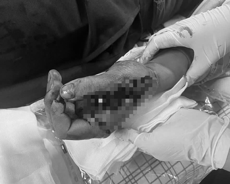 Tai nạn trong tích tắc vì pháo nổ, nam thanh niên suýt mất chức năng bàn tay- Ảnh 3. Tai nạn trong tích tắc vì pháo nổ, nam thanh niên suýt mất chức năng bàn tay- Ảnh 3.