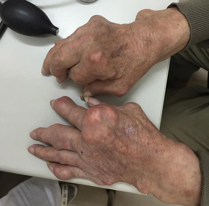 Gout mạn tính gây biến dạng khớp tay, chân xử trí ra sao?- Ảnh 1. Gout mạn tính gây biến dạng khớp tay, chân xử trí ra sao?- Ảnh 1.