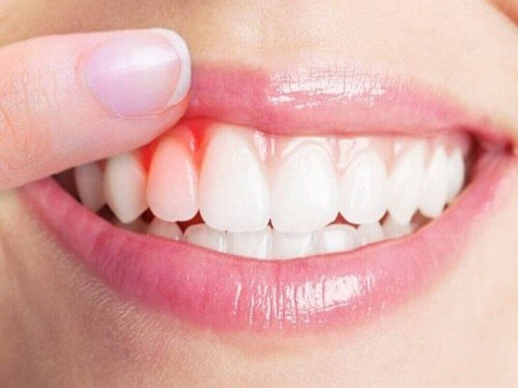 Nguyên nhân thường gặp gây chảy máu miệng và cách xử trí tại nhà- Ảnh 1.