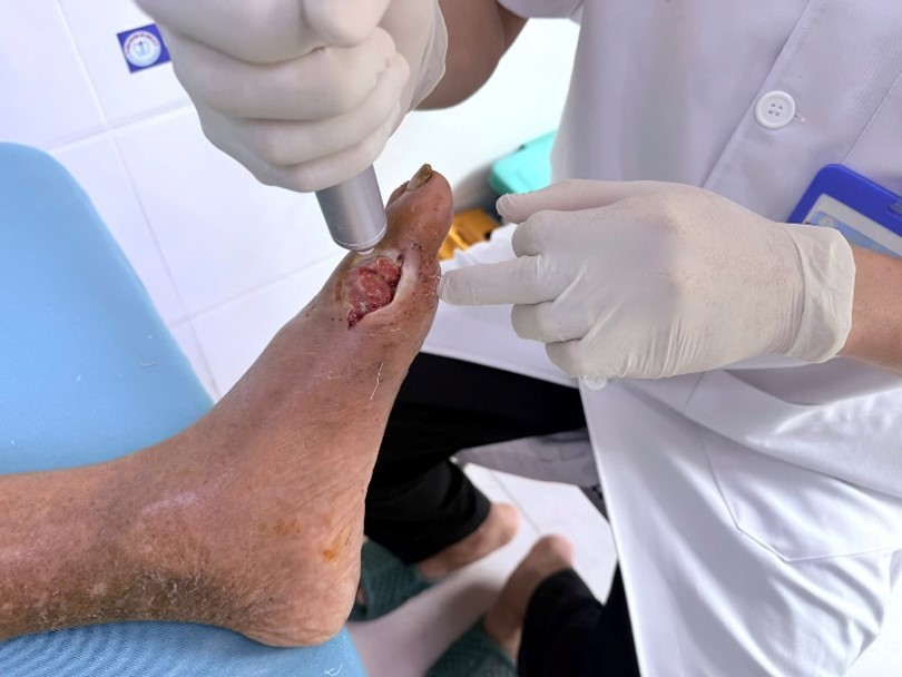 Ứng dụng kỹ thuật cao, Bệnh viện Nội tiết Nghệ An nâng hiệu quả điều trị loét bàn chân- Ảnh 3. Ứng dụng kỹ thuật cao, Bệnh viện Nội tiết Nghệ An nâng hiệu quả điều trị loét bàn chân- Ảnh 3.