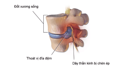 Giảm đau do thoát vị đĩa đệm ở người cao tuổi dùng thuốc như thế nào?- Ảnh 2. Giảm đau do thoát vị đĩa đệm ở người cao tuổi dùng thuốc như thế nào?- Ảnh 2.