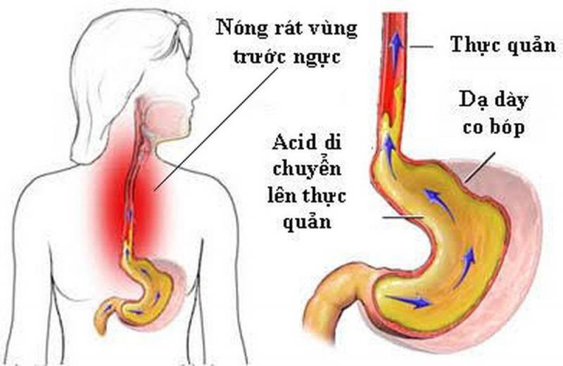 5 nguy cơ khi dùng nhiều thuốc giảm tiết acid ở người trào ngược dạ dày - thực quản- Ảnh 1. 5 nguy cơ khi dùng nhiều thuốc giảm tiết acid ở người trào ngược dạ dày - thực quản- Ảnh 1.
