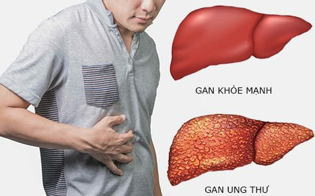 Yếu tố nguy cơ làm tăng tỷ lệ mắc ung thư gan- Ảnh 1. Yếu tố nguy cơ làm tăng tỷ lệ mắc ung thư gan- Ảnh 1.