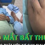Da và mắt vàng bất thường, chàng trai 21 tuổi bàng hoàng phát hiện xơ gan giai đoạn cuối