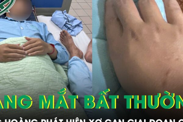 Da và mắt vàng bất thường, chàng trai 21 tuổi bàng hoàng phát hiện xơ gan giai đoạn cuối