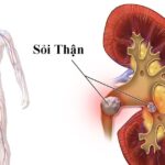 Nhập viện vì sỏi thận, chuyên gia khuyến cáo cần phát hiện sớm khi có biểu hiện này