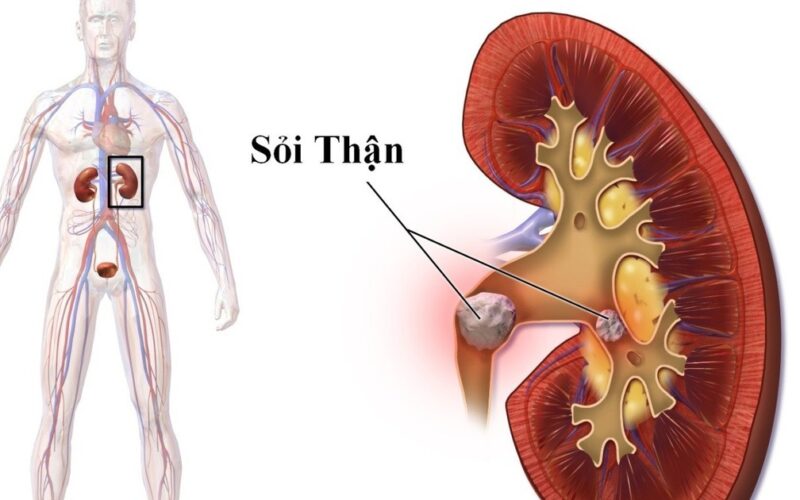 Nhập viện vì sỏi thận, chuyên gia khuyến cáo cần phát hiện sớm khi có biểu hiện này