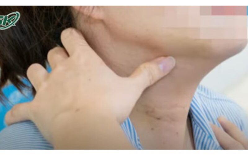 Viêm tuyến giáp mạn tính có làm tăng nguy cơ ung thư tuyến giáp không ?