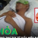 Bé trai 14 tuổi nguy kịch vì bệnh dại sau 6 tháng bị chó nhà cắn