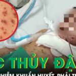 Biến chứng thủy đậu, bé trai 6 tuổi nhiễm khuẩn huyết, phải thở máy nguy kịch