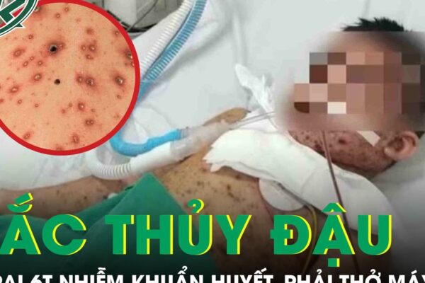 Biến chứng thủy đậu, bé trai 6 tuổi nhiễm khuẩn huyết, phải thở máy nguy kịch