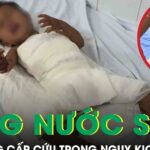 Bé 22 tháng tuổi bỏng nước sôi cấp cứu trong nguy kịch