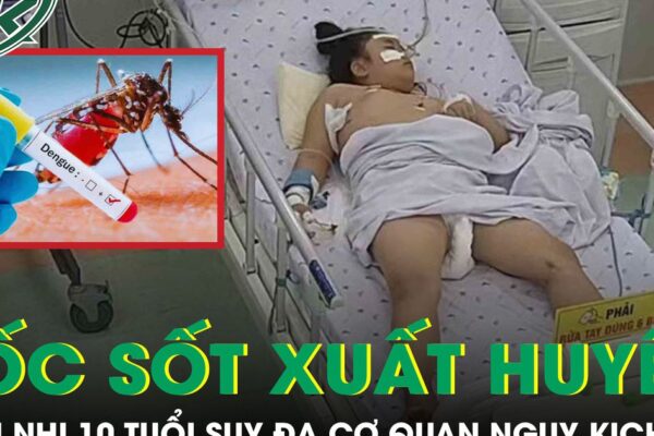 Sốc sốt xuất huyết, bệnh nhi 10 tuổi suy đa cơ quan, tổn thương gan cấp tính nguy kịch