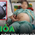 Tá hoả phát hiện khối u buồng trứng ‘cực khủng’ gần 30cm từ dấu hiệu đau bụng
