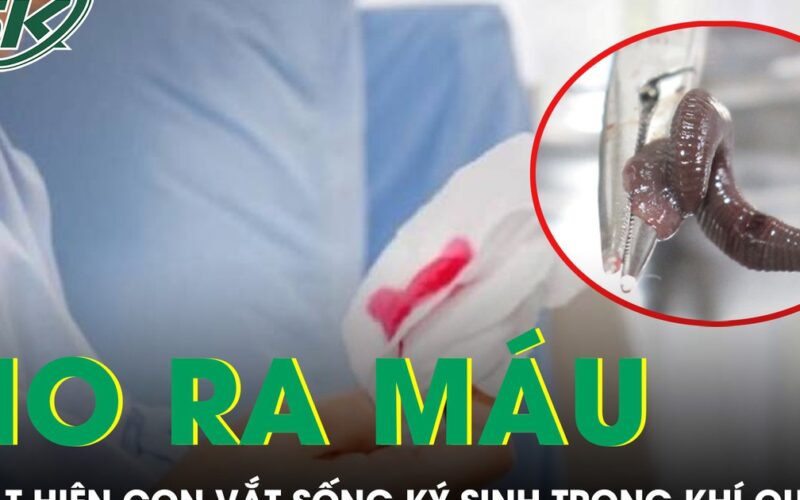 Ho ra máu suốt một tháng, bàng hoàng phát hiện con vắt sống ký sinh trong khí quản