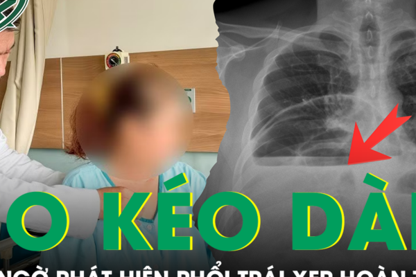 Ho kéo dài nhiều tuần, người phụ nữ bất ngờ phát hiện phổi trái xẹp hoàn toàn vì bệnh hiếm