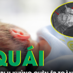 Cứu trẻ sơ sinh 10 ngày tuổi mang khối u hiếm gặp, chèn ép toàn bộ ổ bụng
