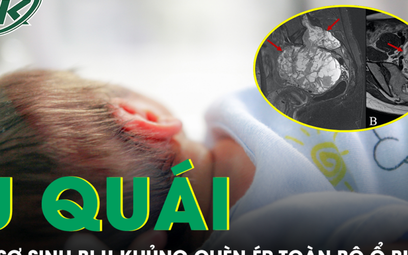 Cứu trẻ sơ sinh 10 ngày tuổi mang khối u hiếm gặp, chèn ép toàn bộ ổ bụng