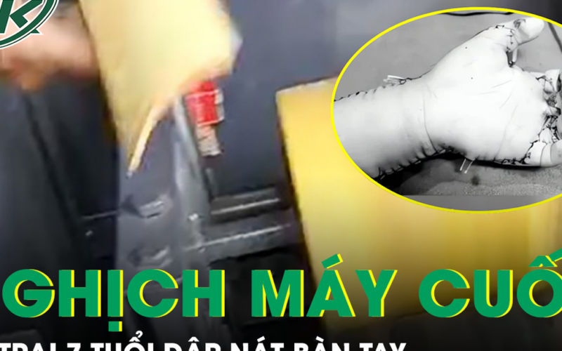 Bé 7 tuổi ở Lào Cai bị máy cuốn dập nát bàn tay do nghịch máy bào quế tự chế