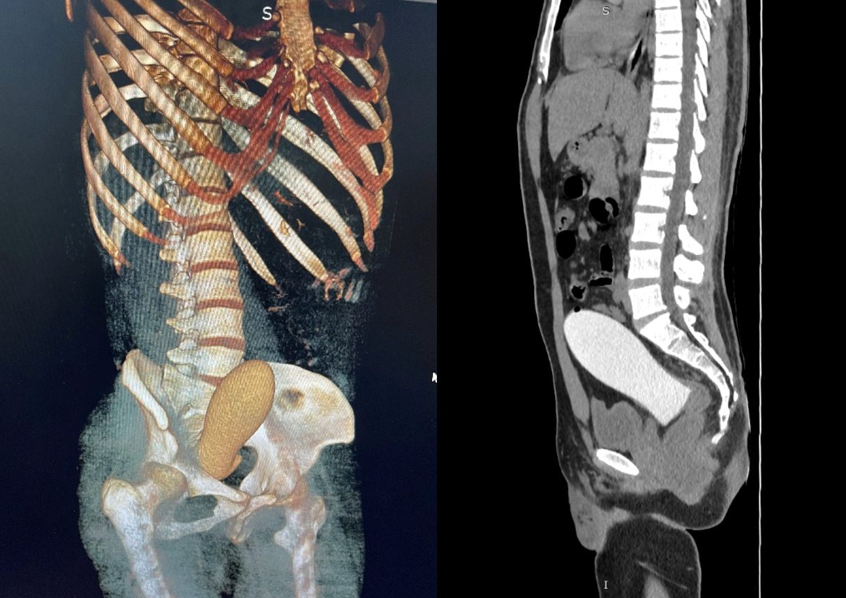Nam thanh niên phải cấp cứu vì mắc 'trứng rồng' hơn 13cm trong trực tràng khi thủ dâm- Ảnh 1.