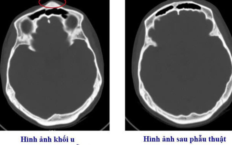 Bệnh viện Việt Nam – Thụy Điển Uông Bí phẫu thuật thành công ca u xương sọ hiếm gặp