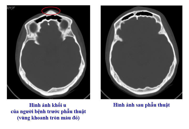 benh-vien-viet-nam-thuy-dien-uong-bi-phau-thuat-thanh-cong-ca-u-xuong-so-hiem-gap-17790937867871653492967 Bệnh viện Việt Nam - Thụy Điển Uông Bí phẫu thuật thành công ca u xương sọ hiếm gặp- Ảnh 1.