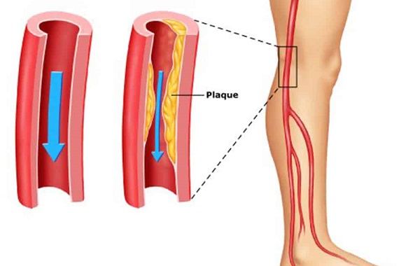 Suýt mất chân vì tắc động mạch cấp chi dưới, bác sĩ cảnh báo dấu hiệu không nên bỏ qua- Ảnh 2.