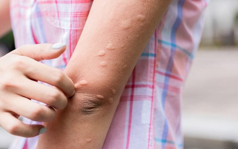 Mề đay dễ bùng phát khi nắng nóng: 3 cách làm giảm ngứa, dịu da