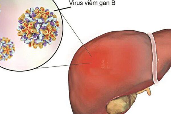 Viêm gan B có lây qua ăn uống, ôm hôn không và cách phòng tránh