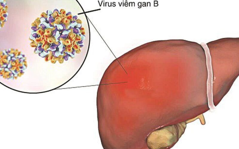 Viêm gan B có lây qua ăn uống, ôm hôn không và cách phòng tránh