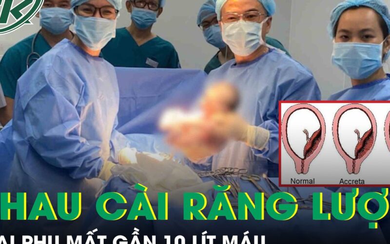 Thai phụ 36 tuần mất gần 10 lít máu, nguy hiểm tính mạng vì tai biến nhau cài răng lược