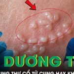 Có phải HPV dương tính là bị ung thư cổ tử cung không?