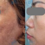 Bác sĩ chỉ rõ lý do nhiều người trị nám tốn kém nhưng vẫn tái phát
