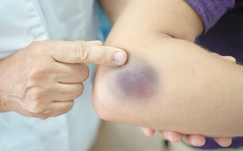 Xuất hiện nhiều vết bầm tím không rõ nguyên nhân cảnh giác với giảm tiểu cầu